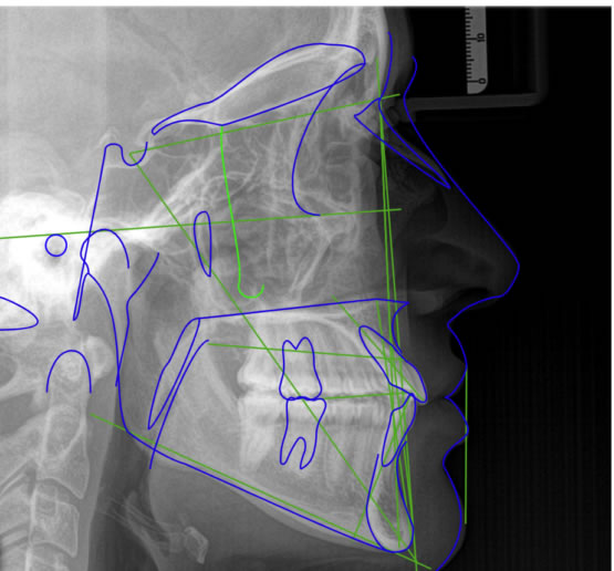 Traçado cefalométrico sobre telerradiografia lateral de crânio.